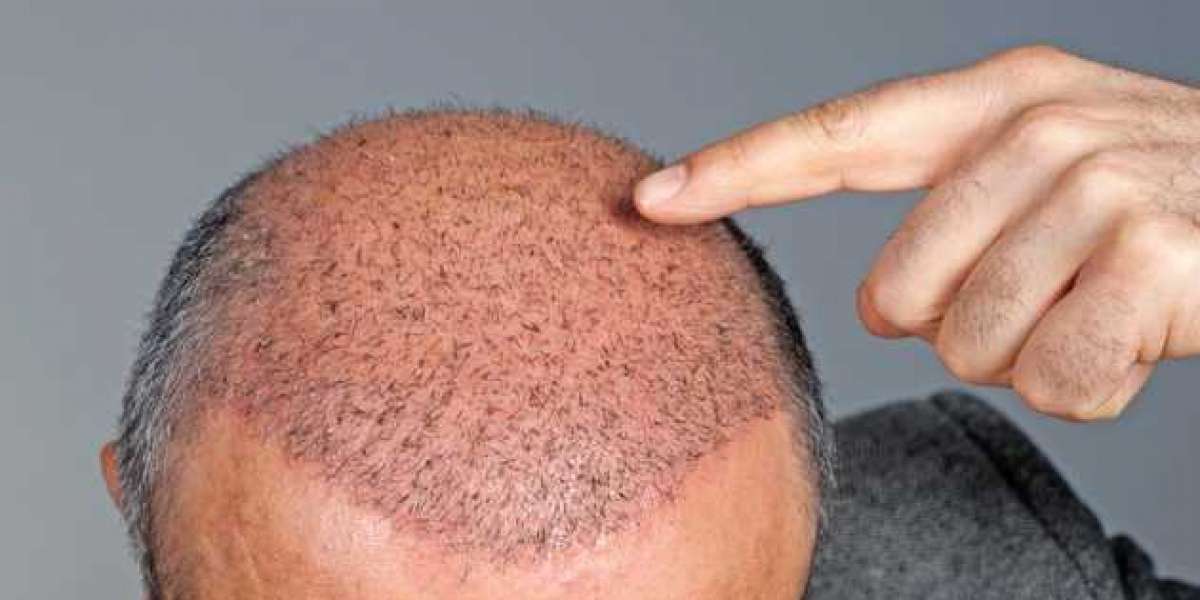 Cost of hair restoration