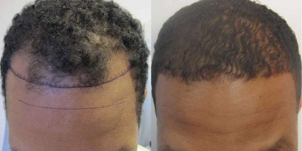 Hair Restoration African American